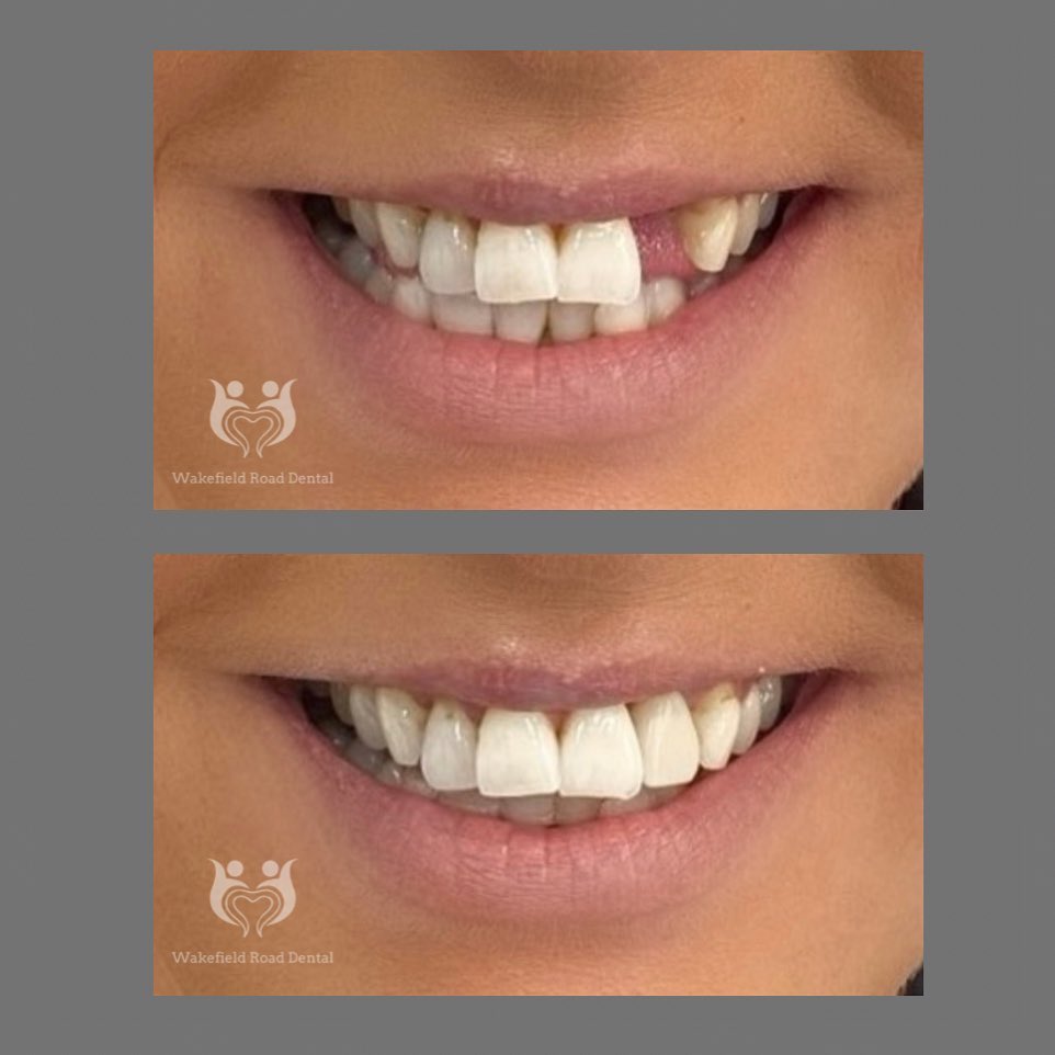 Invisalign journey
